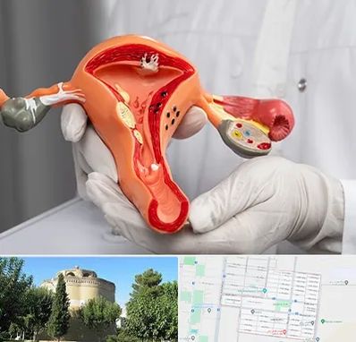 دکتر سرطان رحم در مرداویج اصفهان 