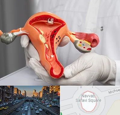 دکتر سرطان رحم در نواب 