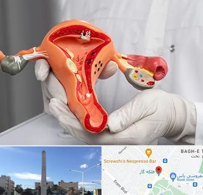 دکتر سرطان رحم در فلکه گاز شیراز 