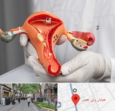 دکتر سرطان رحم در ولیعصر شهریار