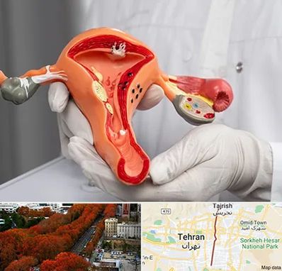 دکتر سرطان رحم در ولیعصر 