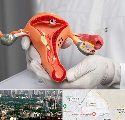 دکتر سرطان رحم در عظیمیه کرج 