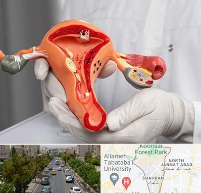 دکتر سرطان رحم در شهران 