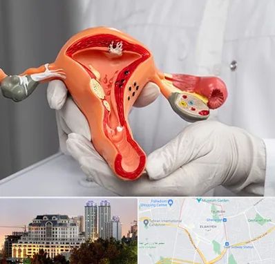 دکتر سرطان رحم در فرشته 