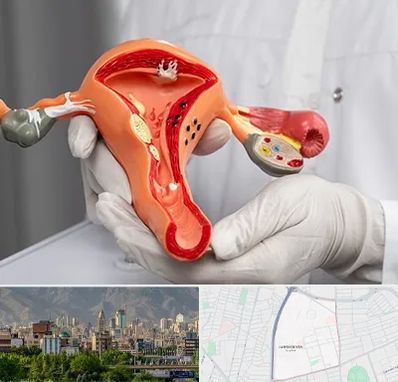 دکتر سرطان رحم در جمشیدیه