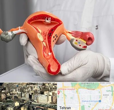 دکتر سرطان رحم در مرزداران 