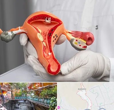 دکتر سرطان رحم در درکه