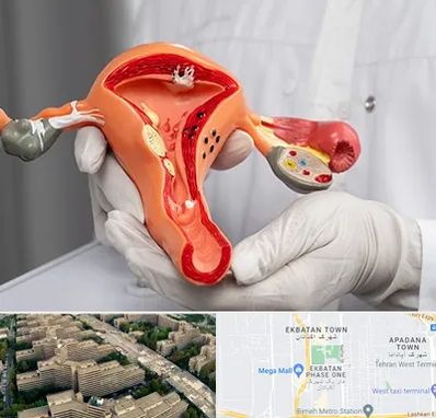 دکتر سرطان رحم در اکباتان 