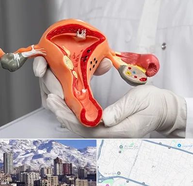 دکتر سرطان رحم در ازگل