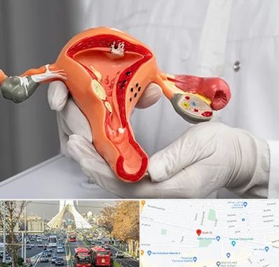 دکتر سرطان رحم در خیابان آزادی 