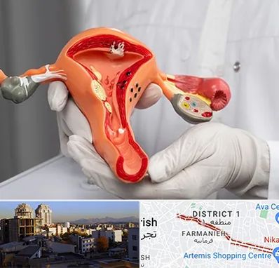 دکتر سرطان رحم در فرمانیه 