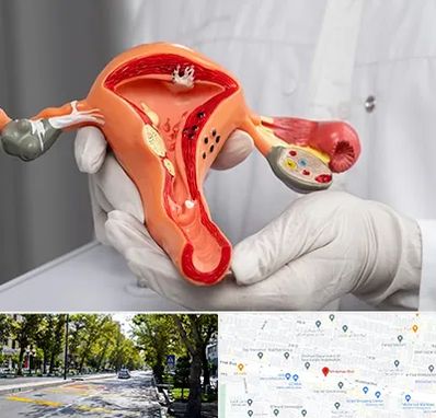 دکتر سرطان رحم در میرداماد 