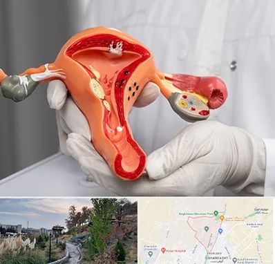 دکتر سرطان رحم در باغستان کرج 