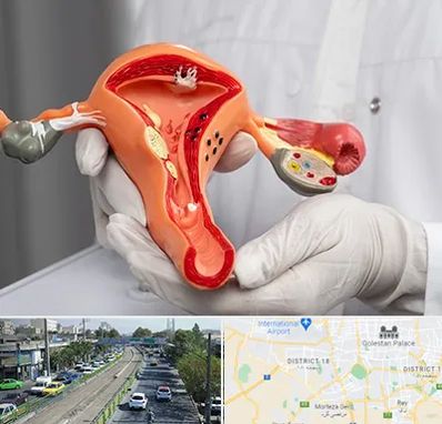 دکتر سرطان رحم در جنوب تهران 