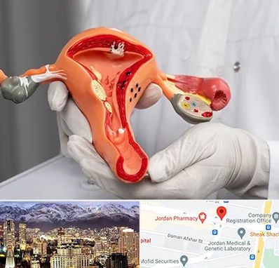 دکتر سرطان رحم در جردن 