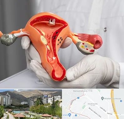 دکتر سرطان رحم در شهر زیبا 