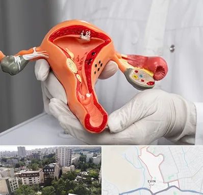 دکتر سرطان رحم در اوین