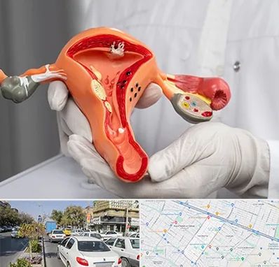 دکتر سرطان رحم در مفتح مشهد 