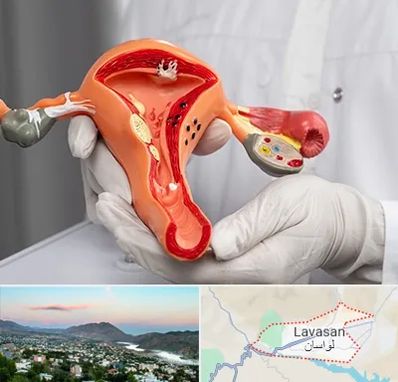 دکتر سرطان رحم در لواسان