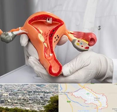 دکتر سرطان رحم در یاسوج