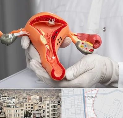 دکتر سرطان رحم در اسکندری