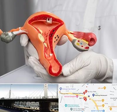 دکتر سرطان رحم در پارک وی 