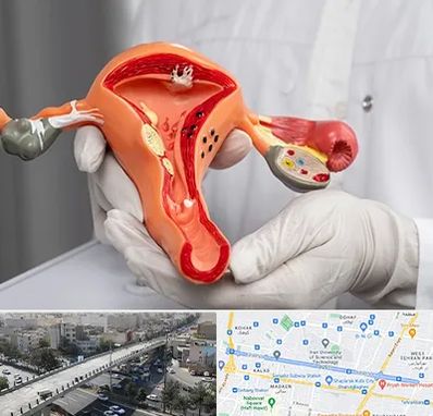 دکتر سرطان رحم در فرجام 