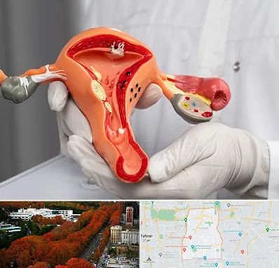 دکتر سرطان رحم در منطقه 6 تهران 