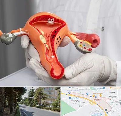 دکتر سرطان رحم در مهرویلا کرج 