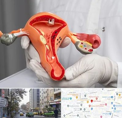 دکتر سرطان رحم در فاطمی 