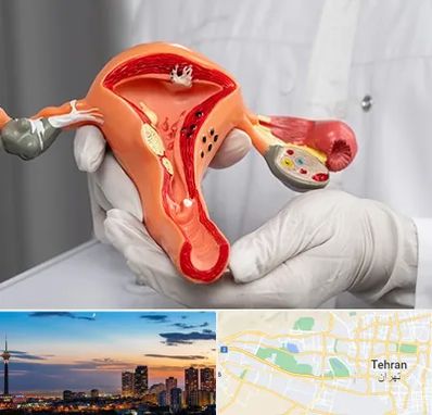 دکتر سرطان رحم در غرب تهران 