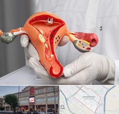 دکتر سرطان رحم در قائمیه اسلامشهر