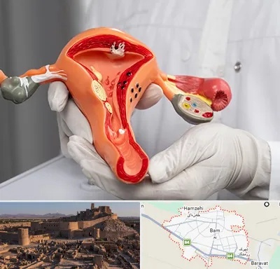 دکتر سرطان رحم در بم