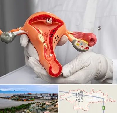 دکتر سرطان رحم در بندر ترکمن