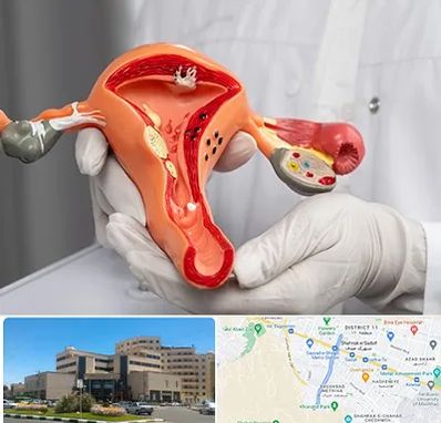 دکتر سرطان رحم در صیاد شیرازی مشهد 