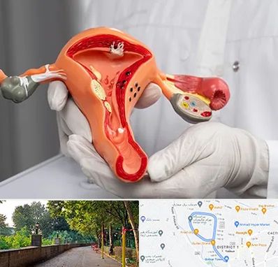 دکتر سرطان رحم در بلوار گیلان رشت 