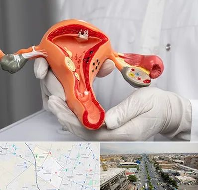 دکتر سرطان رحم در حصارک کرج 