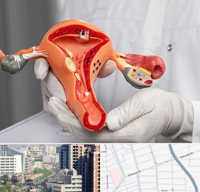 دکتر سرطان رحم در خیابان بهشتی