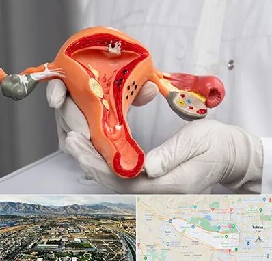 دکتر سرطان رحم در منطقه 21 تهران 