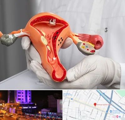 دکتر سرطان رحم در آبرسان تبریز