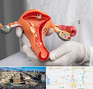 دکتر سرطان رحم در شهرک راه آهن 