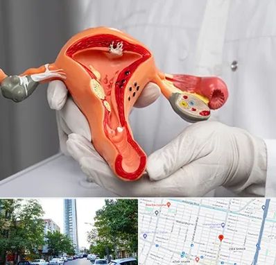 دکتر سرطان رحم در امامت مشهد 