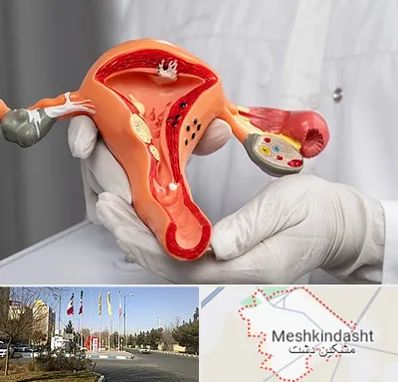 دکتر سرطان رحم در مشکین دشت