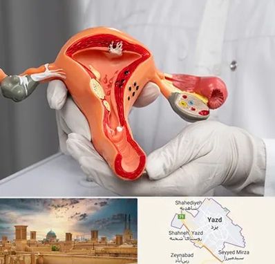 دکتر سرطان رحم در یزد