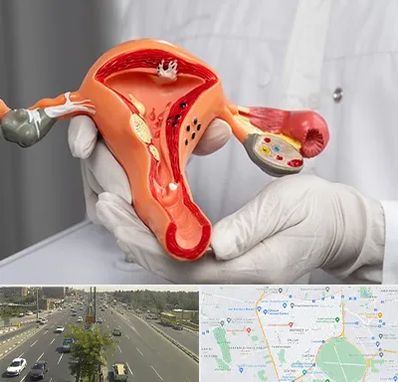 دکتر سرطان رحم در منطقه 17 تهران 