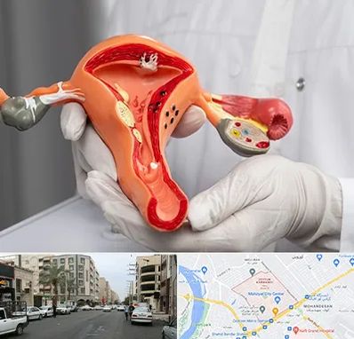 دکتر سرطان رحم در زیتون کارمندی اهواز 