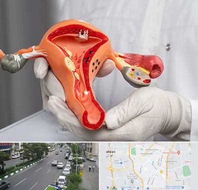 دکتر سرطان رحم در ستارخان 