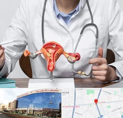 جراح سرطان رحم در نصف راه تبریز