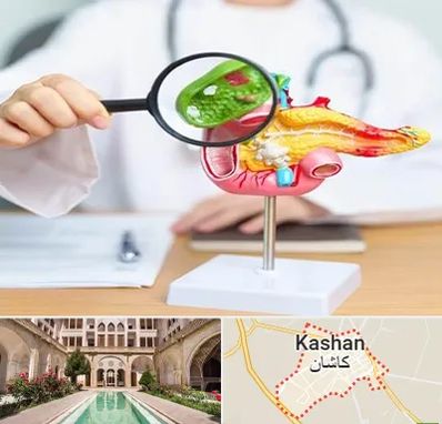 جراح سرطان پانکراس در کاشان