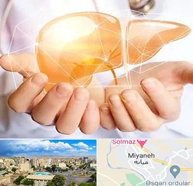 دکتر سرطان کبد در میانه